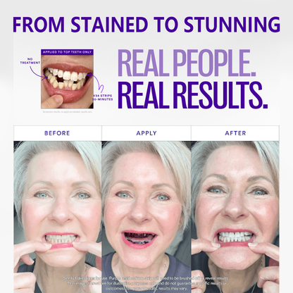 🔥V36 Whitening Strips – Professional Teeth Whitening at Home